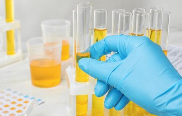 آشنایی با برخی علل رنگ غیر طبیعی ادرار آشنایی با برخی علل رنگ غیر طبیعی ادرار